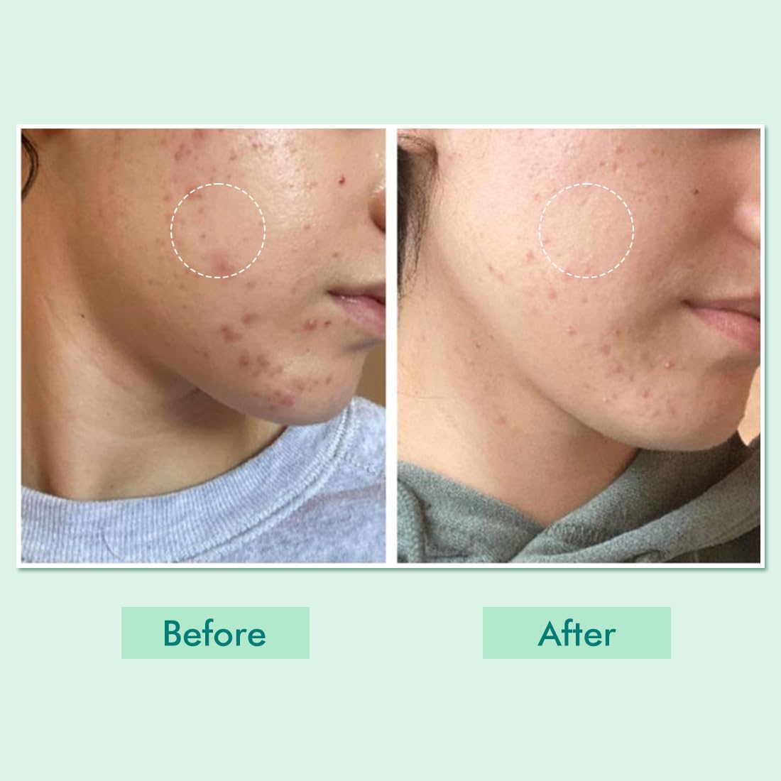 mCaffeine 10% Niacinamide & Panthenol, Vitamin B5 Oil-Free Moisturizer for Acne with Matcha Tea| Lightweight Hydration & Soothes Skin | Non-greasy, Fragrance-Free | For Oily, Acne Prone Skin - 50ml