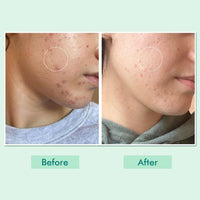 mCaffeine 10% Niacinamide & Panthenol, Vitamin B5 Oil-Free Moisturizer for Acne with Matcha Tea| Lightweight Hydration & Soothes Skin | Non-greasy, Fragrance-Free | For Oily, Acne Prone Skin - 50ml