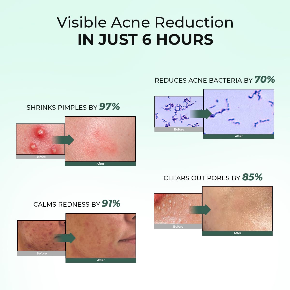 Conscious Chemist® Rapid Relief Acne Spot Corrector Gel | 15g | Triple-Action Treatment with 2% Salicylic Acid & Azelaic Acid | Clears Pimples, Reduces Redness & Fades Dark Spots | For Men & Women