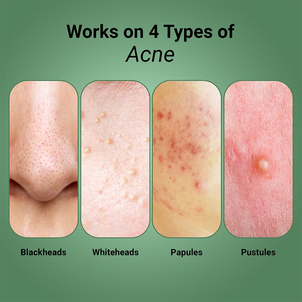 Sereko Clear Corrective Serum with 2% Encapsulated Salicylic Acid BHA & 3% Azelaic Acid | Active Acne | Reducing Sebum Production | Pigmentation & Dark Spots for Oily | Acne-Prone Skin 30ml - Pack 1