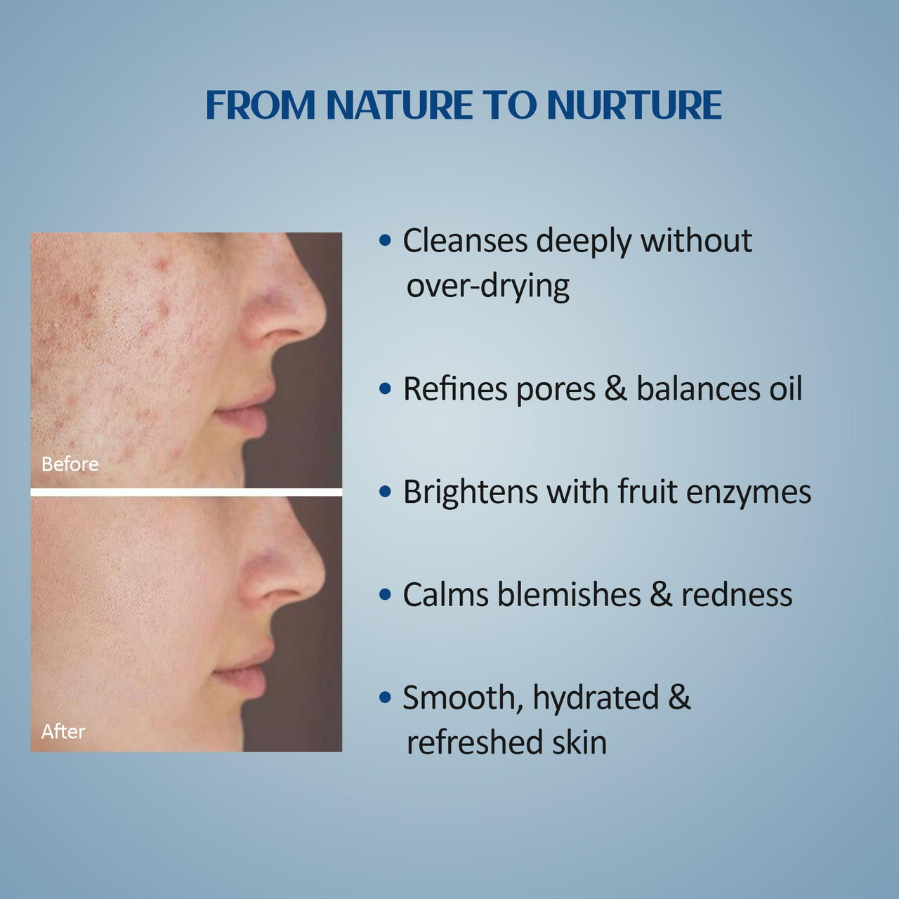 Suun Ayurveda Anti-Acne Face Serum for Pimples, Blackheads & Acne Scars | With 2% Encapsulated Salicylic Acid, 5% Niacinamide, Coffee Leaf & Red Clove Oil | Controls Oil, Clears Skin & Soothes Inflammation | 30 ml