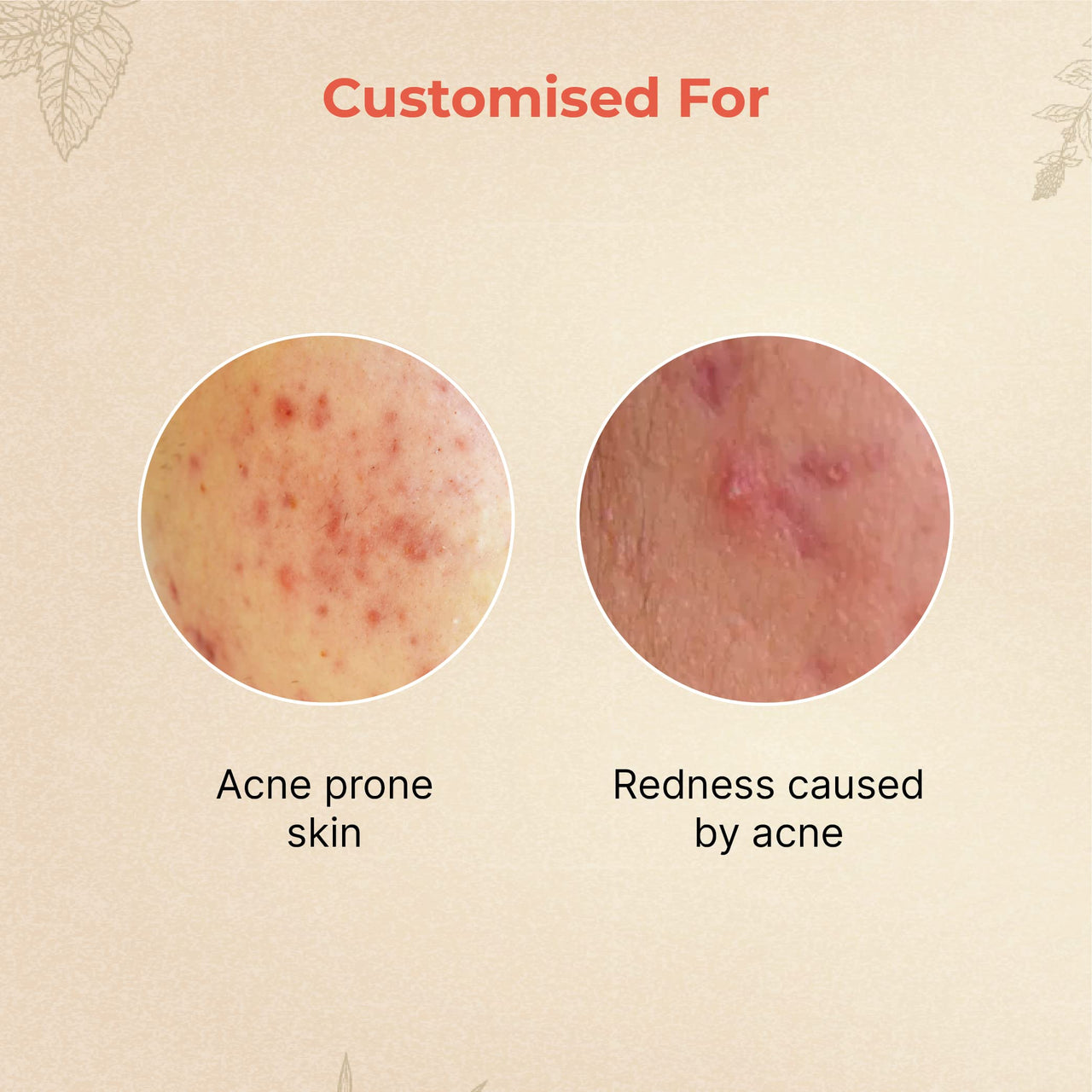 Vedix Customised Ayurvedic Face Oil | Abhyud Face Oil For Acne Prone Skin | With Kushtha + Chamomile + Kamala | For Acne Prone Skin | For Dull Skin | 10ml