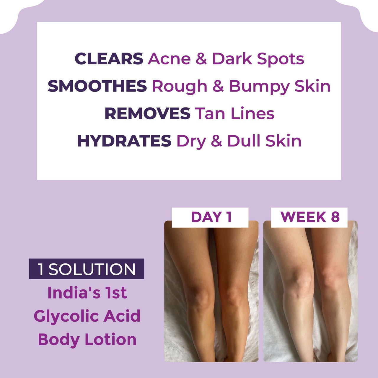 Sanfe Clear & Confident Glycolic Acid Body Lotion | Daily AHA Exfoliation for Rough & Bumpy Skin, Tan, Acne & Strawberry Skin | Niacinnamide, Lactic Acid SALICYLIC ACID 1% W/w | Smooth Skin from 1st Use | 200ml