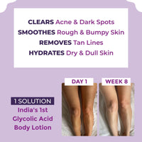 Sanfe Clear & Confident Glycolic Acid Body Lotion | Daily AHA Exfoliation for Rough & Bumpy Skin, Tan, Acne & Strawberry Skin | Niacinnamide, Lactic Acid SALICYLIC ACID 1% W/w | Smooth Skin from 1st Use | 200ml