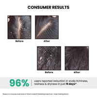 ThriveCo AHA BHA PHA Exfoliating Scalp Scrub | Promotes Hair Growth, Clears Dandruff, Dead Skin, Oil & Product Buildup | Works on Dry, Flaky & Itchy Scalp | For Men & Women | Travel-Friendly | 25ml