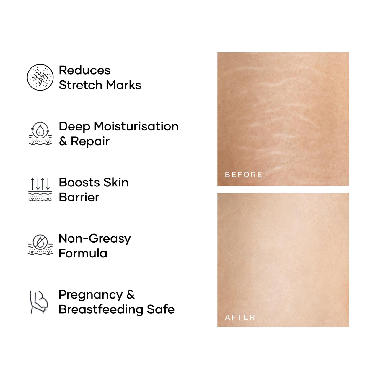 Cureskin Smoothing Body Butter Stretch Marks Cream for Women and Men | Stretch Marks Removal Cream for Women