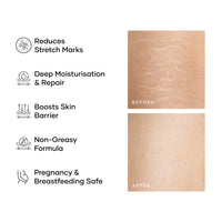 Cureskin Smoothing Body Butter Stretch Marks Cream for Women and Men | Stretch Marks Removal Cream for Women