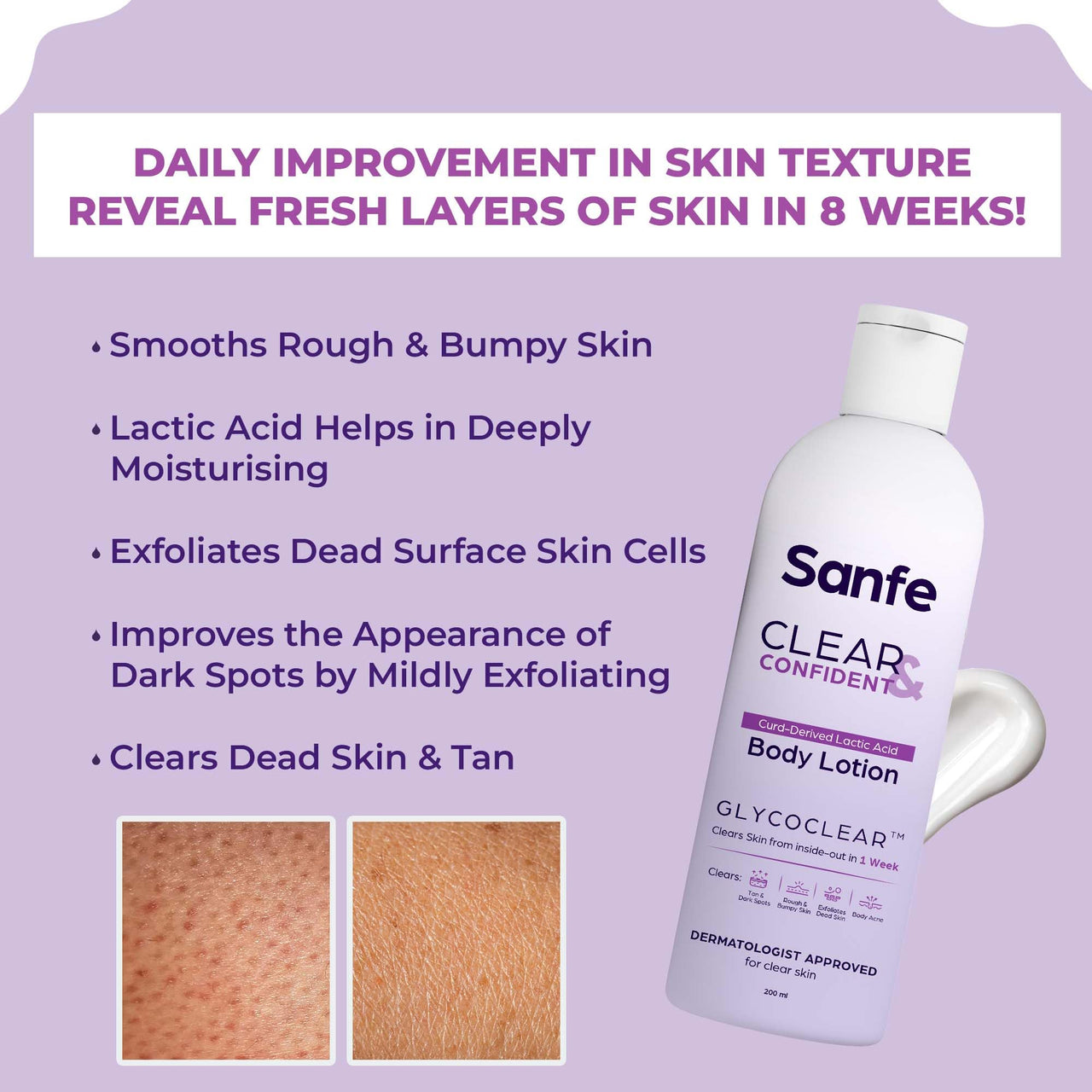 Sanfe Clear & Confident Glycolic Acid Body Lotion | Daily AHA Exfoliation for Rough & Bumpy Skin, Tan, Acne & Strawberry Skin | Niacinnamide, Lactic Acid SALICYLIC ACID 1% W/w | Smooth Skin from 1st Use | 200ml