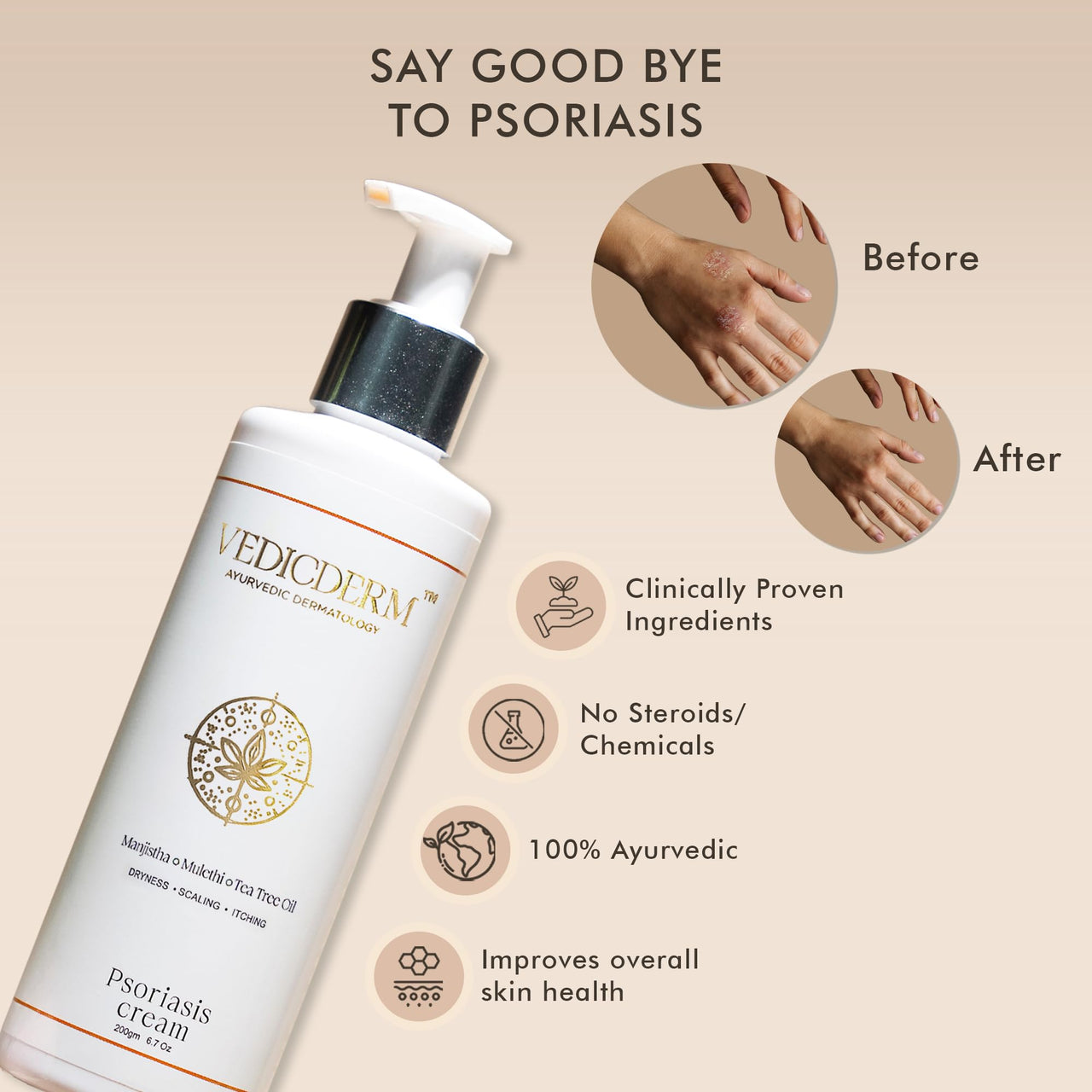 VEDICDERM Psoréa Cream with 2% Bakuchi Extract Skin Barrier Repair | Itching and Dryness Control | Natural, Chemical Free Formula for Psoriatic skin (200ml, Pack of 1)