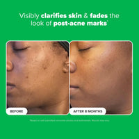 Paula's Choice BOOST 10% Azelaic Acid Booster Cream Gel Face Serum with Salicylic Acid, Oil-Free Skin Brightening Serum for Face, Fragrance-Free - 5 ml