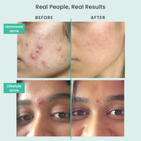 THE SOLVED SKIN India's 1st Dermatologically Tested Acnewash With Patented Micronized Benzoyl Peroxide. Kills 99% Acne Causing Bacteria, & Calms Inflamed Pimples in 4 Days. Normal to Oily Skin. 100ml (1, 100ml (Pack of 1))