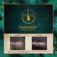 Indulekha Svetakutaja Oil|Ayurvedic Medicinal oil for dandruff treatment|100% Ayurvedic Oil|100ml