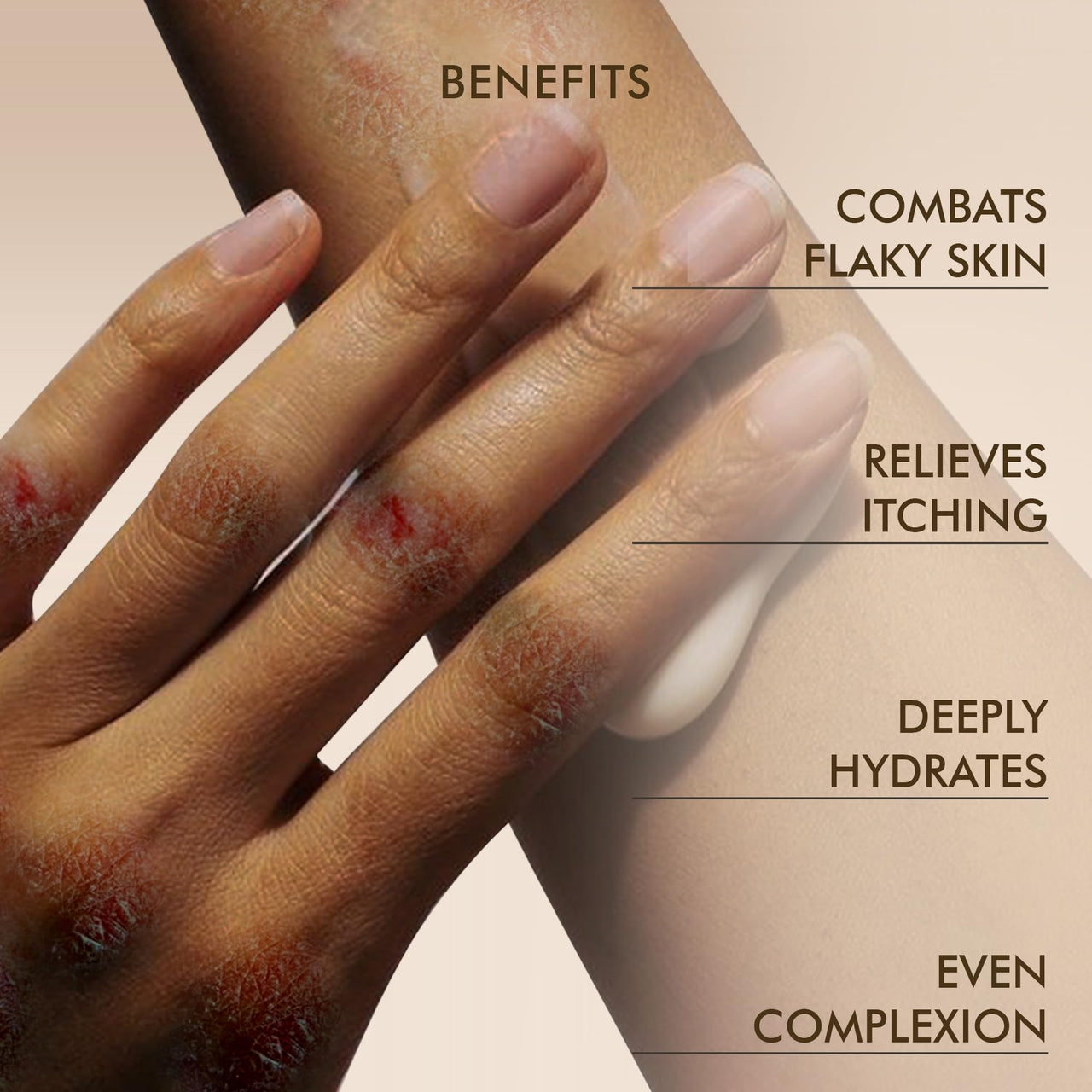 VEDICDERM Natural Psoriasis Cream for Dry Itchy Skin Steroid-Free Formula with Ayurvedic Herbs Helps Soothe Redness, Flakiness & Irritation Moisturizing Body Cream for Sensitive Skin (200ml Pack of 2)