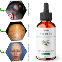 Gunja Ratti Pure & Natural Hair Oil for Alopecia & Scalp Therapy | Alopecia Areata & Beard Growth Oil for Men and Women
