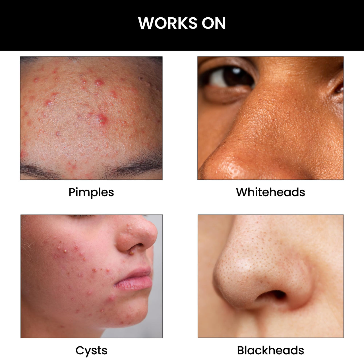 ThriveCo Goodbye Acne™ Face Wash | Reduces Acne-Causing Bacteria & Sebum Production | Men & Women, 100ml