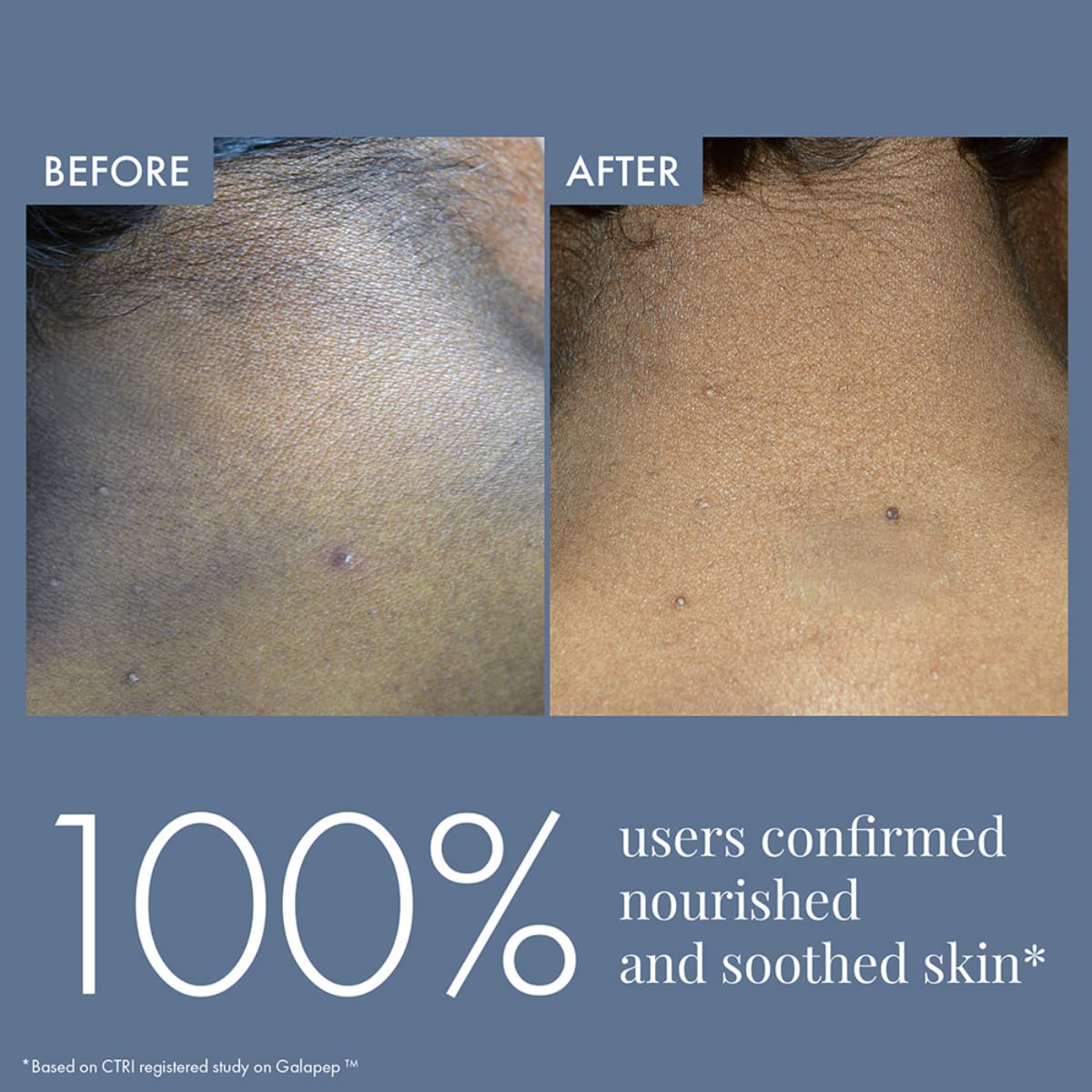 ThriveCo Dark Patches Corrector Cream| Dark Patches Removal | With Retinal &Niacinamide for Dark Neck, Underarms, Inner Thighs, Knuckles, Elbows & Knees. Men & Women | 100ml