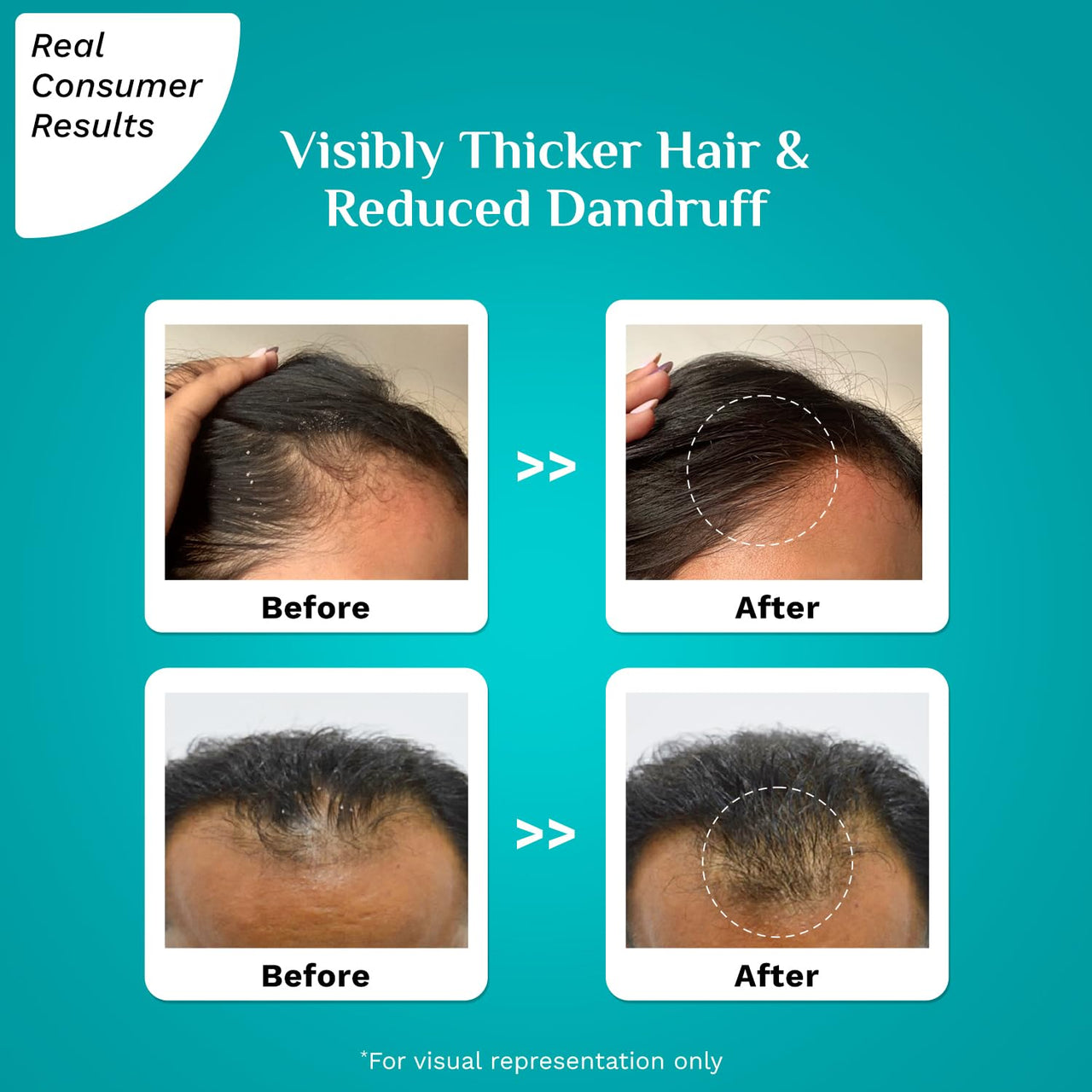 Pilgrim 3% Redensyl & 4% Anagain ADVANCED HAIR GROWTH SERUM (30 ml) For Dandruff-Prone Scalp | Controls Dandruffs, Hair Fall, Stimulates Hair Growth, Increase Hair Density | For All Men & Women