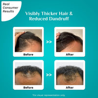 Pilgrim 3% Redensyl & 4% Anagain ADVANCED HAIR GROWTH SERUM (30 ml) For Dandruff-Prone Scalp | Controls Dandruffs, Hair Fall, Stimulates Hair Growth, Increase Hair Density | For All Men & Women