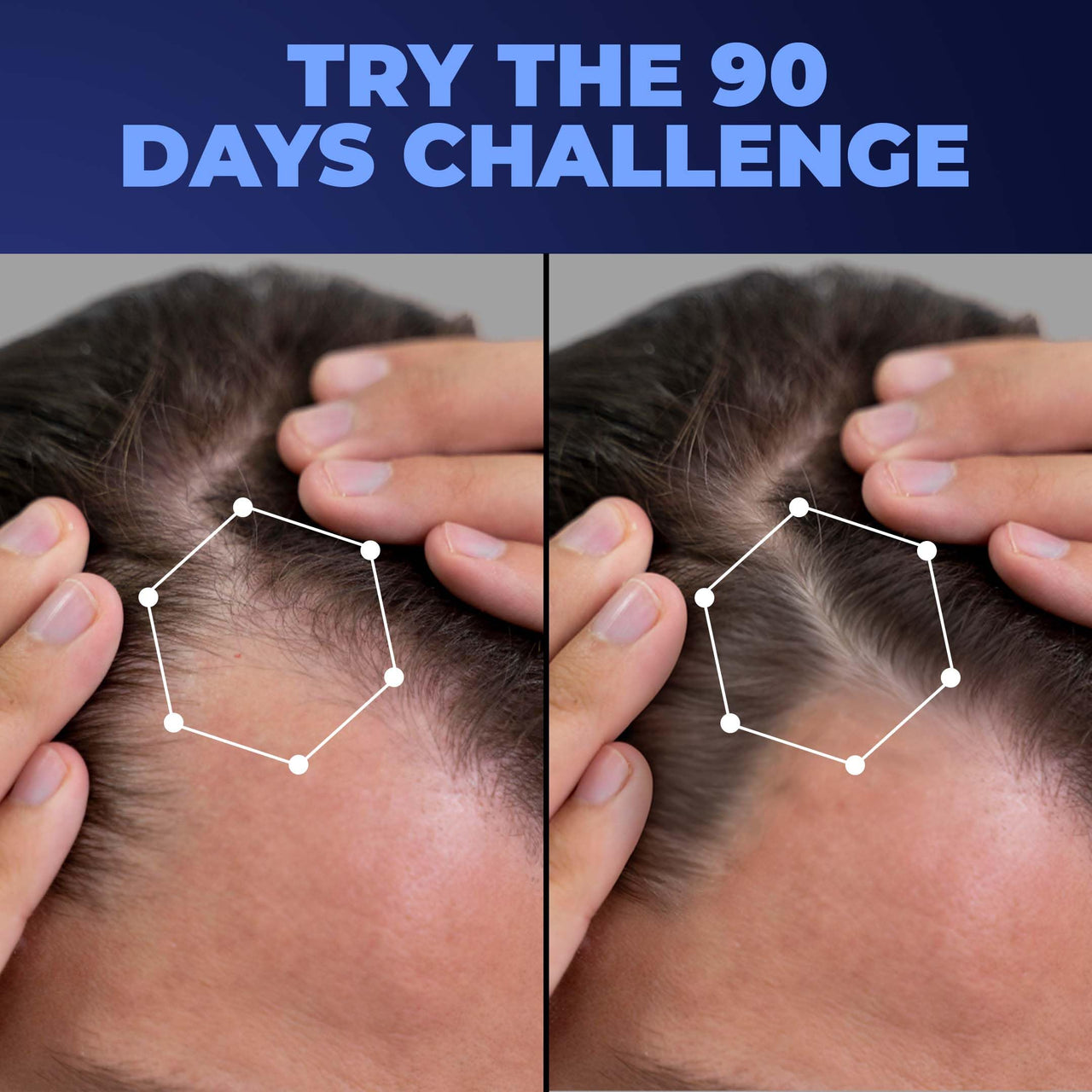 Dr. Beardo Advanced Hair Growth Serum for Men, 50 ml| Contains 3% Redensyl, 3% Baicapil, Rosemary | Stimulates Hair Growth, Increase Hair Density & Thickens Hair | Lightweight and Non-Sticky | Made for Men