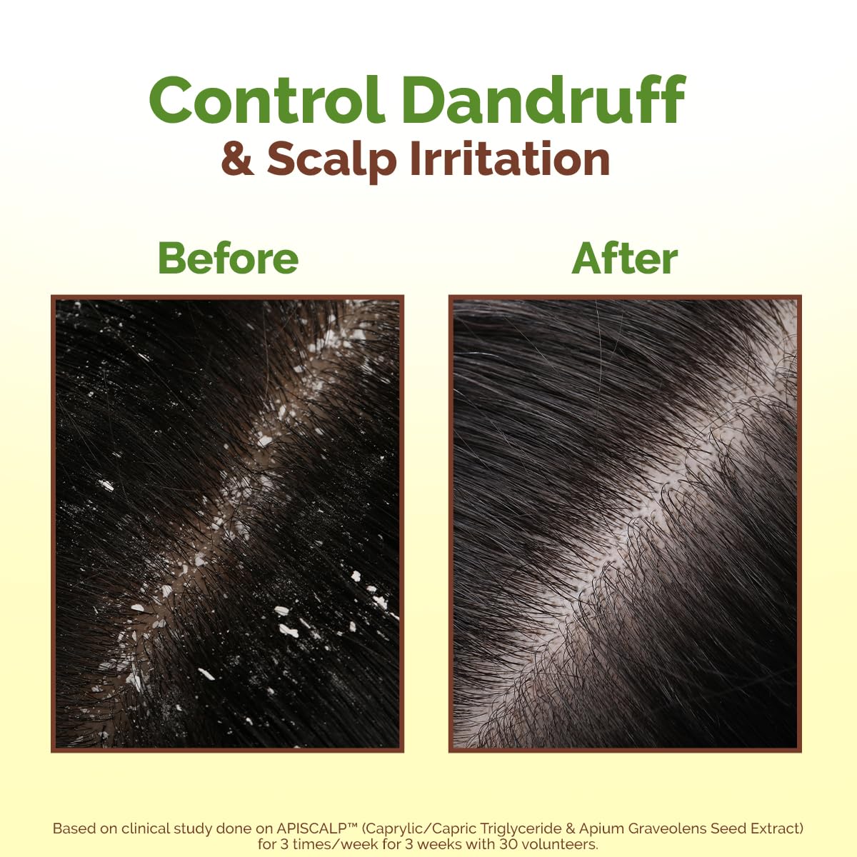 Mamaearth Lemon Anti-Dandruff Hair Oil for Flaky Scalp 100ml|Scalp Irritation Relief|Nourishes Scalp & Hair|Contains Lemon, Ginger, Apiscalp (Clinically Proven), Svetakutaja Oil, Neem, Salicylic Acid