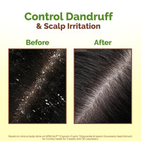 Mamaearth Lemon Anti-Dandruff Hair Oil for Flaky Scalp 100ml|Scalp Irritation Relief|Nourishes Scalp & Hair|Contains Lemon, Ginger, Apiscalp (Clinically Proven), Svetakutaja Oil, Neem, Salicylic Acid