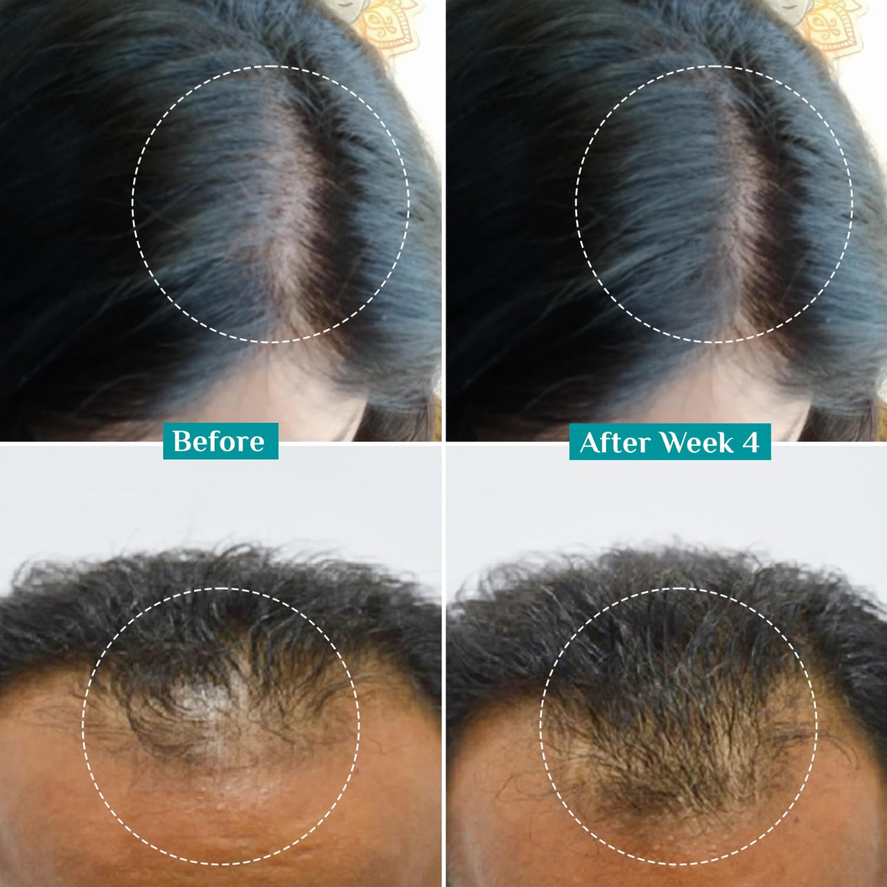 Pilgrim Redensyl 3% + Anagain 4% + Baicapil Advanced Hair Growth Serum (30ml) for Scalp with Korean Black Rice, Saw Palmetto | Control Hair Fall, Stimulate Hair Regrowth, Increase Hair Density | For Women & Men