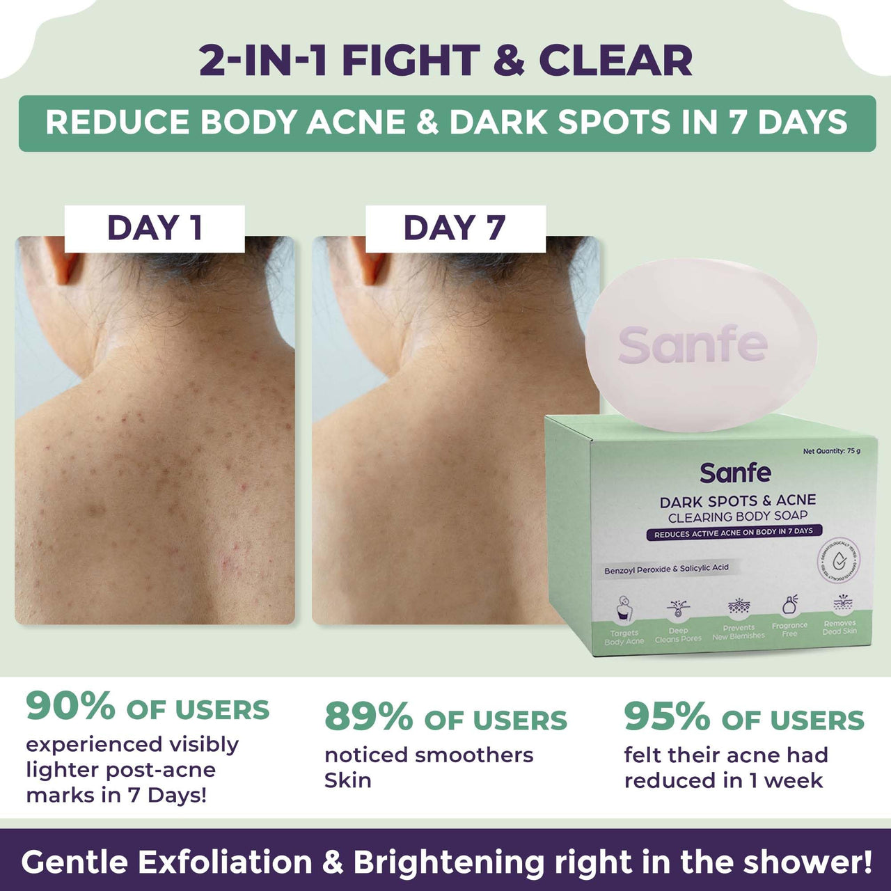 Sanfe Dark Spots & Acne Clearing Body Soap | Prevents Body Acne, Bumpy Skin & Fades Dark Spots | Salicylic Acid 2% W/W, Benzoyl Peroxide | Non Drying Formula (Pack of 1)