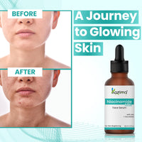 KAZIMA 10% Niacinamide Face Serum for Acne Marks and Dark Spots, with Zinc and Rice Extract | Fades Blemishes, Reduces Hyperpigmentation & Balances Oil | Niacinamide Serum for Oily Skin | 30 ml