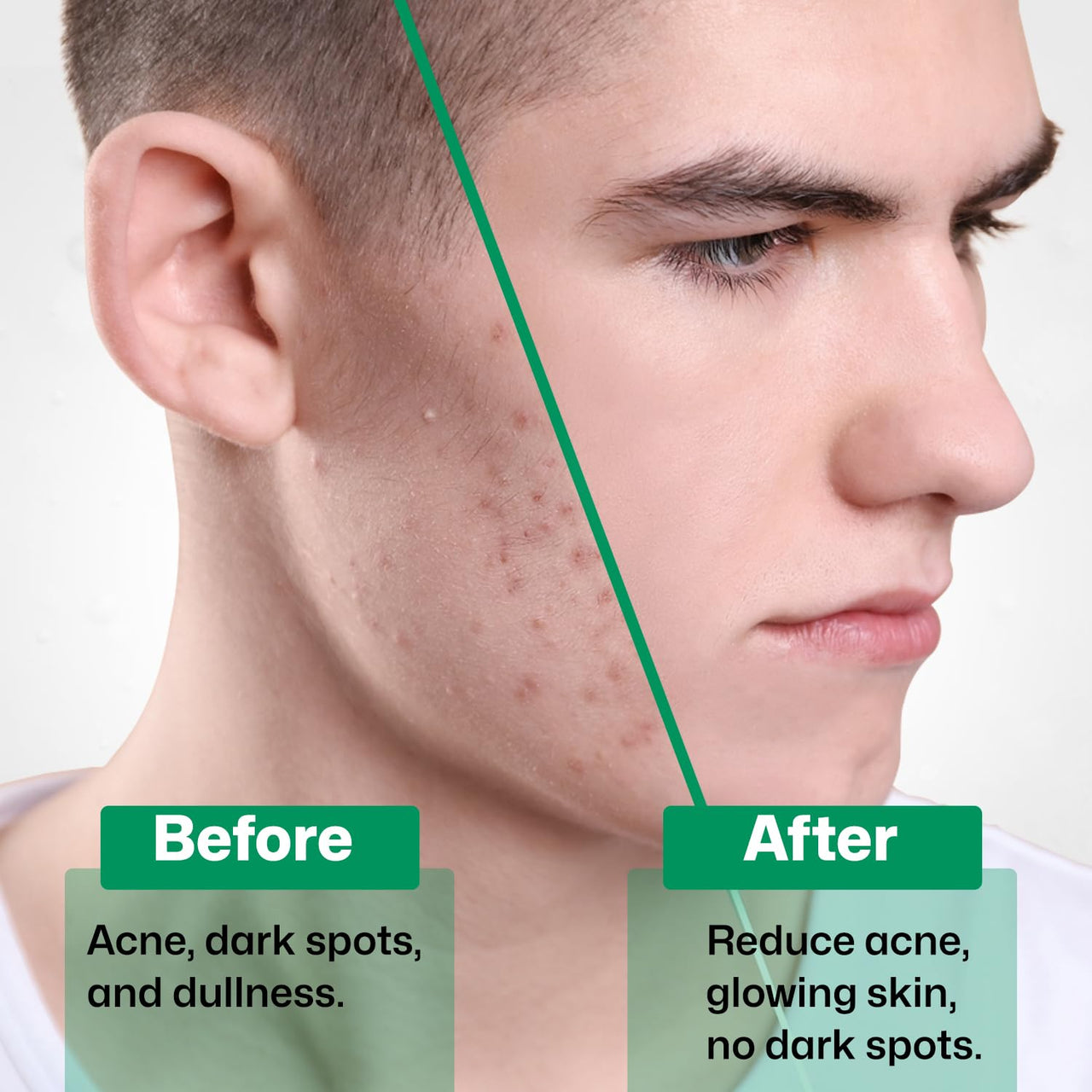 KAZIMA 2% Salicylic Acid Face Serum for Acne, Blackheads & Open Pores | Reduces Excess Oil & Exfoliates Skin | Salicylic Acid Serum for Acne-prone & Oily Skin | For Women & Men | 30 ml