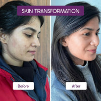 Cos-IQ BHA-2% Encapsulated Salicylic Acid Emulsion Face Serum for Sensitive Skin | Face Exfoliator for Blackheads, Whiteheads, Acne & Open Pores | Reduces Breakouts | For Women & Men | 30ml