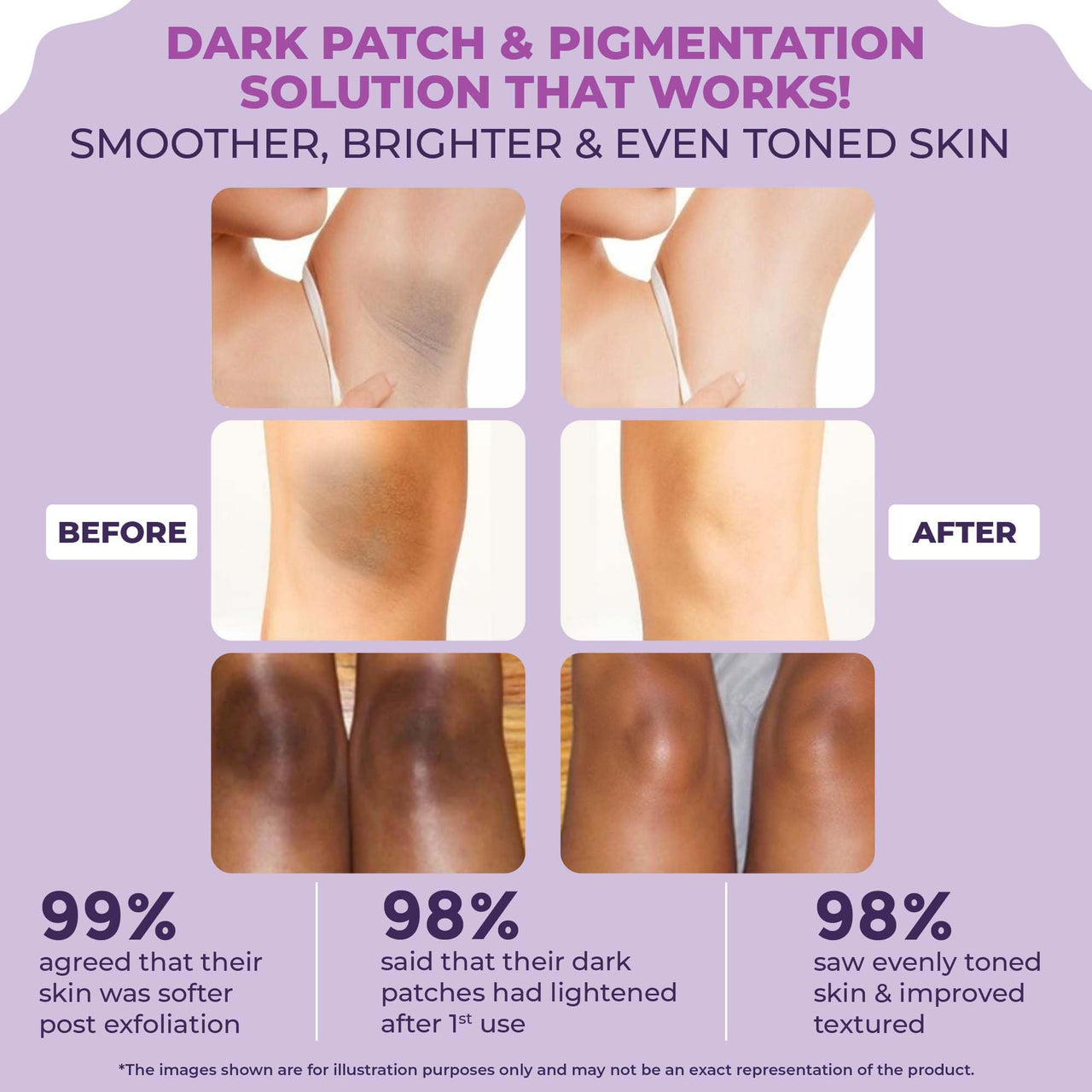 Sanfe Instant Spotlite Mask For Dark Underrams, Neck & Body| Dark Patch Removal Wipe-Off Cream in 10 Minutes | For Detanning, Anti Aging & Skin Tightening | Glycolic & Kojic acid with Charcoal 100g