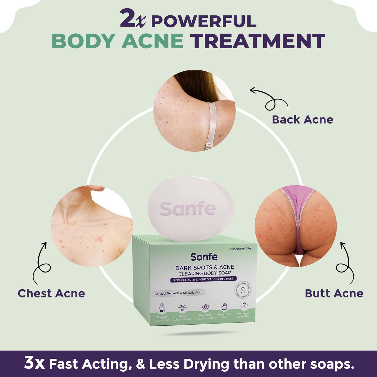 Sanfe Dark Spots & Acne Clearing Body Soap | Prevents Body Acne, Bumpy Skin & Fades Dark Spots | Salicylic Acid 2% W/W, Benzoyl Peroxide | Non Drying Formula (Pack of 1)