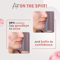 Glamveda 3% Kojic Acid Spot Corrector Gel Reduces Acne Scars & Dark Spots | Glow Booster & Pigmentation Removal | With Alpha Arbutin & Niacinamide | 20g