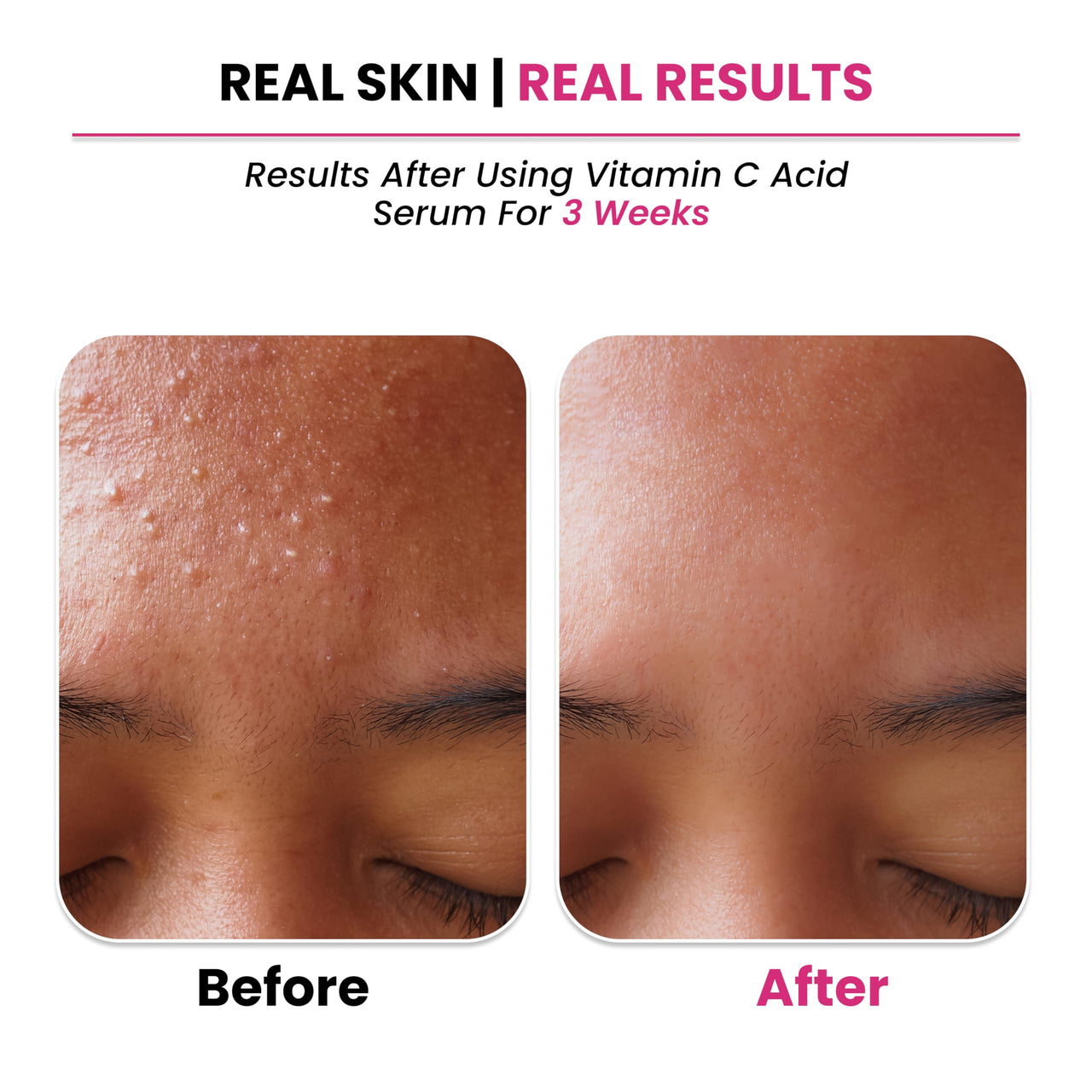 ThriveCo 10% Vitamin C Serum For Face With Hyaluronic Acid | Gives Instant Brightening Effect & Glowing Skin | For Men & Women | All Skin Types | Non-Sticky, Vegan, Fragrance & Cruelty-Free | 30ml