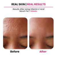 ThriveCo 10% Vitamin C Serum For Face With Hyaluronic Acid | Gives Instant Brightening Effect & Glowing Skin | For Men & Women | All Skin Types | Non-Sticky, Vegan, Fragrance & Cruelty-Free | 30ml