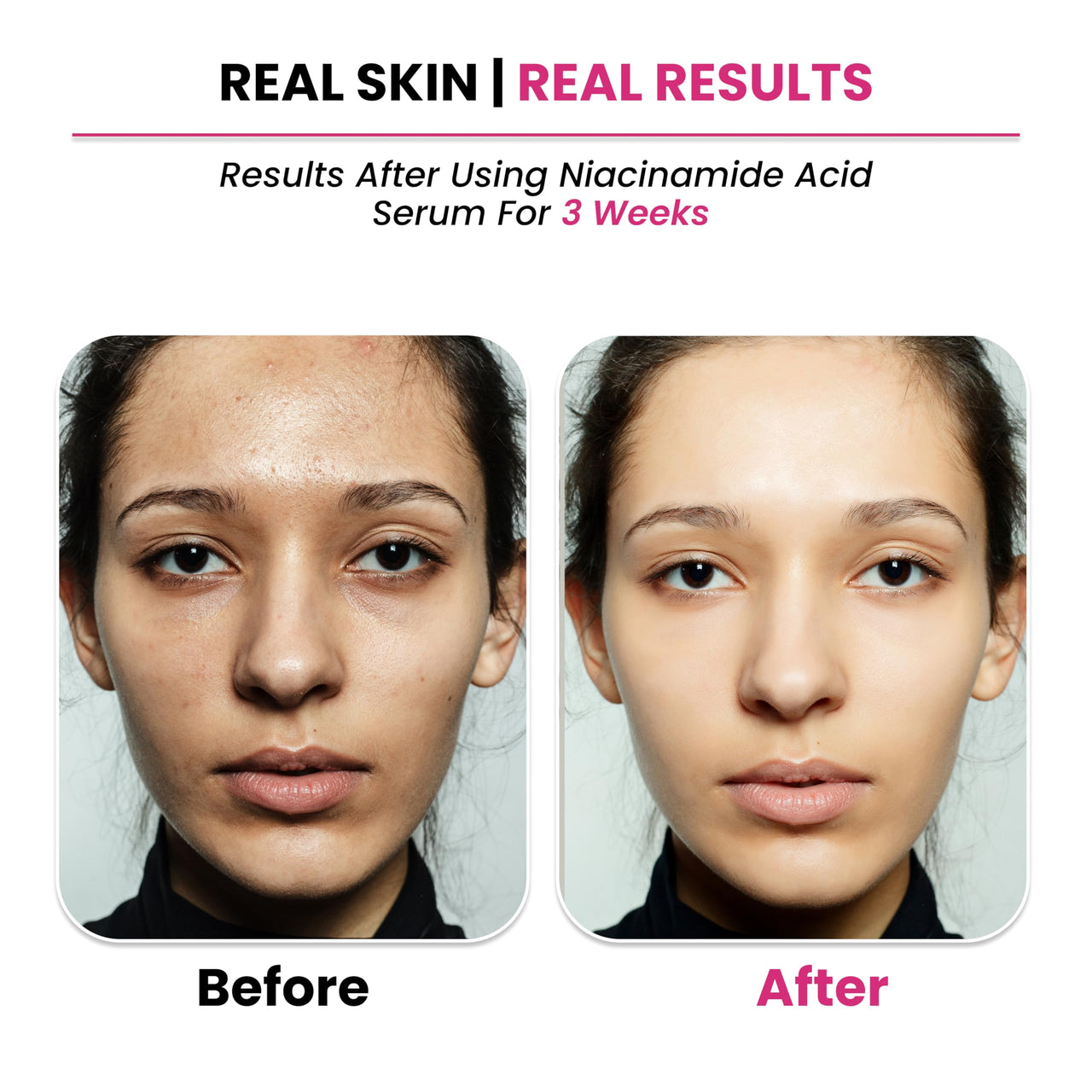 Thriveco 10% Niacinamide Face Serum + 1% Zinc Pca for Clear Glowing Skin | Reduction of Acne | Men & Women, 30ml