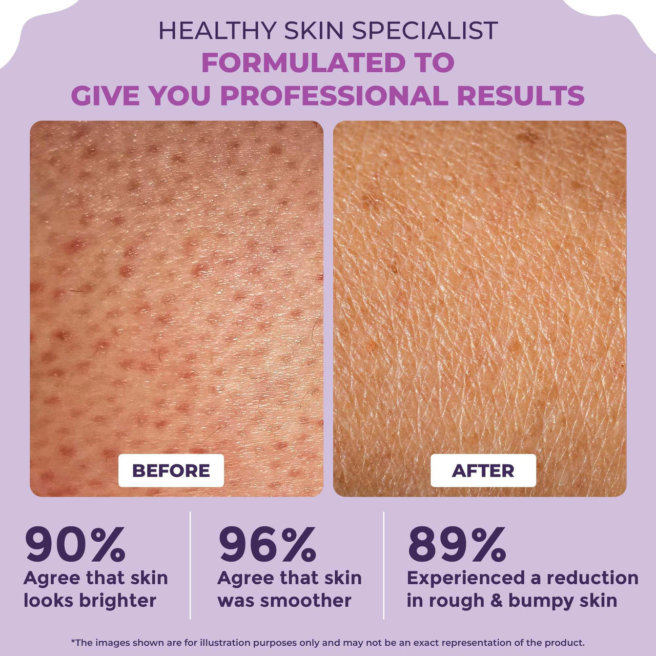 Sanfe Clear & Confident Glycolic Acid Body Lotion | Daily AHA Exfoliation for Rough & Bumpy Skin, Tan, Acne & Strawberry Skin | Niacinnamide, Lactic Acid SALICYLIC ACID 1% W/w | Smooth Skin from 1st Use | 200ml