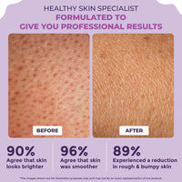 Sanfe Clear & Confident Glycolic Acid Body Lotion | Daily AHA Exfoliation for Rough & Bumpy Skin, Tan, Acne & Strawberry Skin | Niacinnamide, Lactic Acid SALICYLIC ACID 1% W/w | Smooth Skin from 1st Use | 200ml