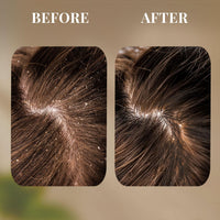 Just Herbs Ayurvedic Anti-Dandruff Shampoo For Strong & Bouncy Hair For Men & Women- Sls & Paraben Free- 200 ml